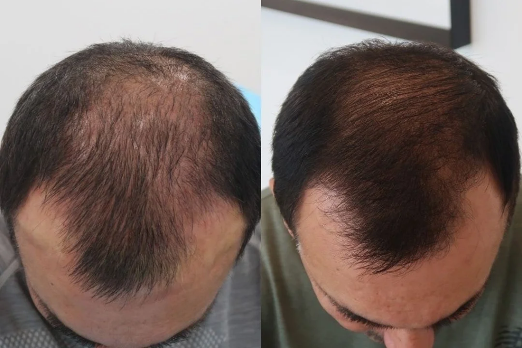 Before & After of Hair Treatment in New Zealand
