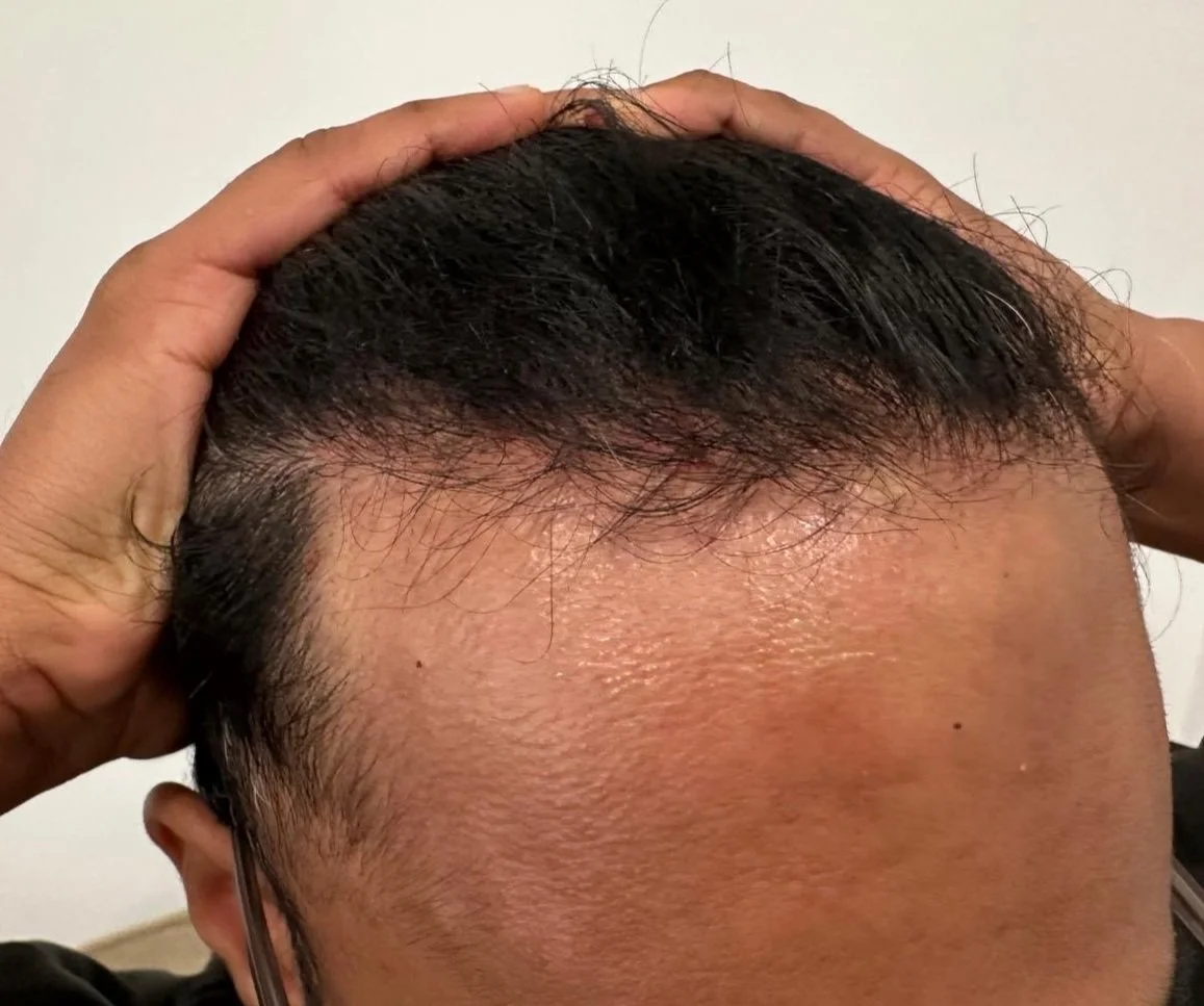 Early-stage hair thinning at the frontal hairline, showing reduced density and visible scalp near the temples