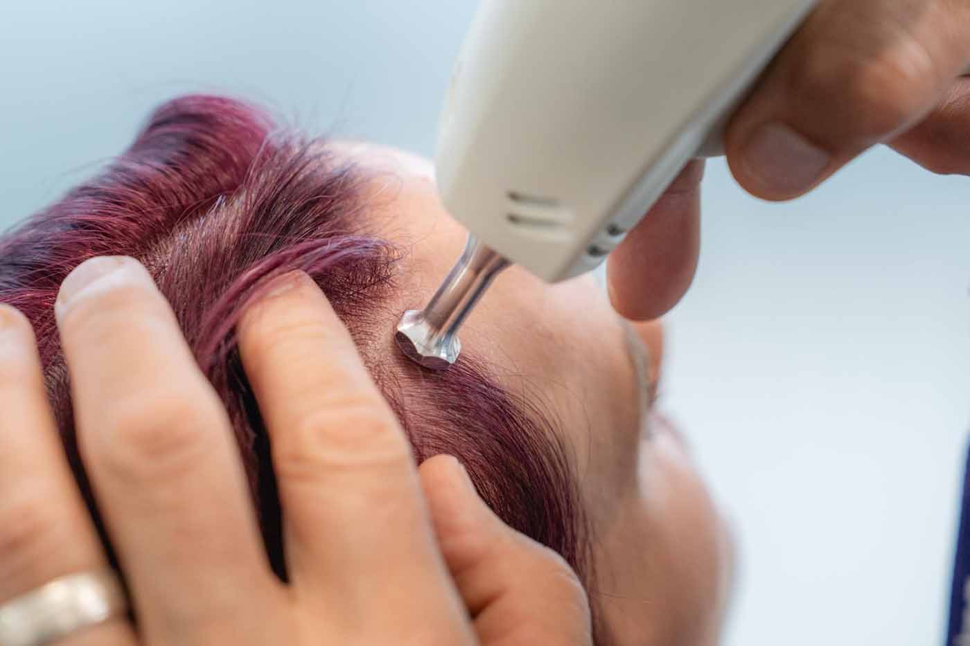 Alma TED device delivering a needle-free hair restoration treatment to the scalp