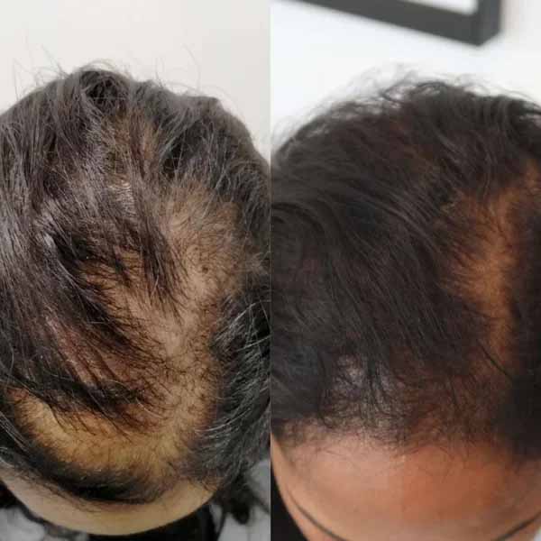 Before-and-after comparison of female pattern hair thinning at the crown, showing scalp density changes after exosome-based hair restoration